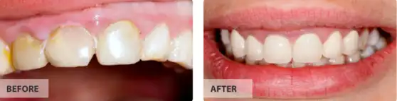 Porcelain Crowns before after image