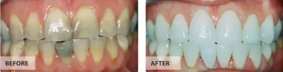 Full Mouth Cosmetic Treatments before after image