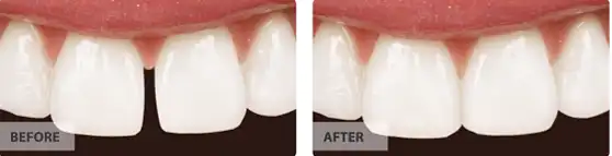 Spacing Treatment before after image