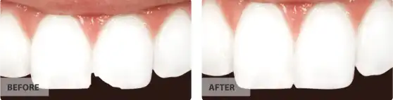 Cosmetic bonding before after image