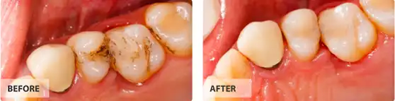 Tooth Colored Fillings before after image